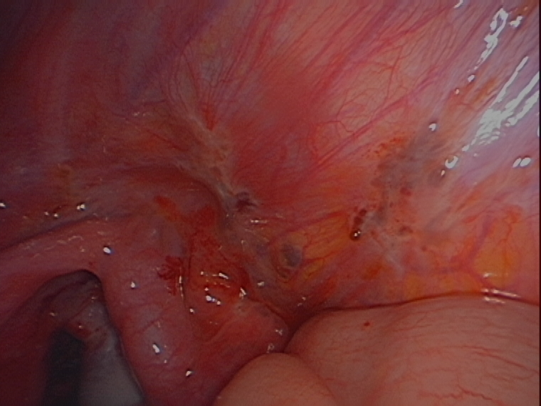 endometriosis right side pelvic wall